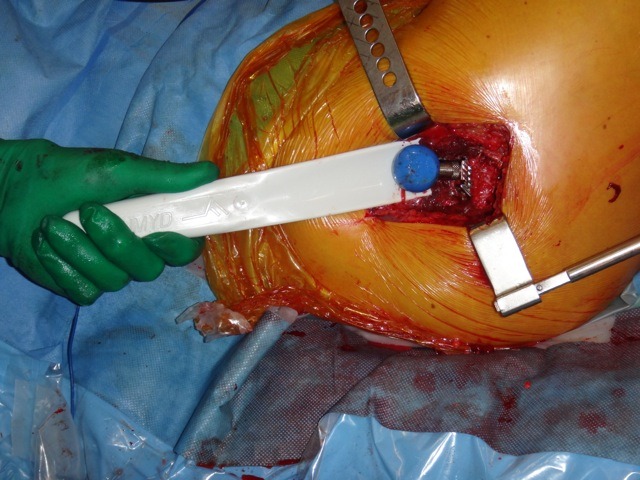 Femoral Head Slide